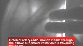 Brachial Artery/Radial Branch Two