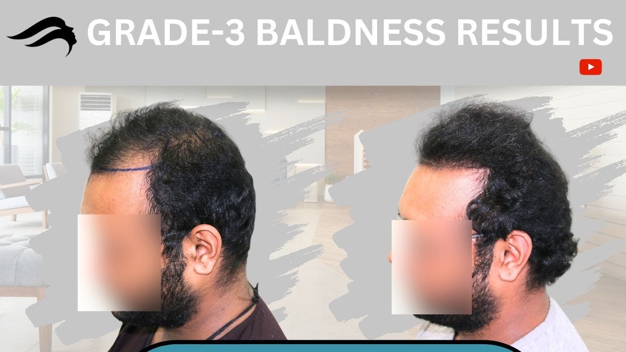 Hair Transplant In Madurai Best Cost Results & Surgeon Of Hair