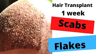 Hair Transplant Turkey Fue Day 7 - 1 Week Update Flaky Hairscabsdizzy