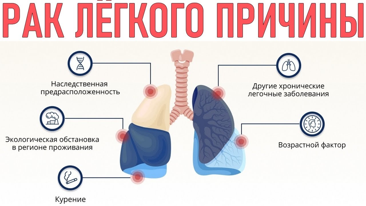 Факторы заболевания рак. Факторы риска развития трак легких. Факторы риска опухоль легких. Карцинома легкого причины.