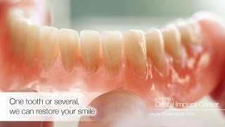 What if multiple teeth need replacing?