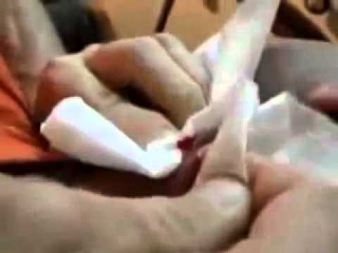 Как лечить атерому