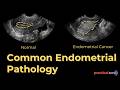 Don't Miss These Causes of Endometrial Thickness