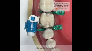 Rhondium QuickConnect Anatomy Matrix Band - Dental Retainerless Tofflemire System - Circumferential