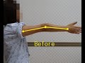 Valgus Stress Test for the Elbow - YouTube