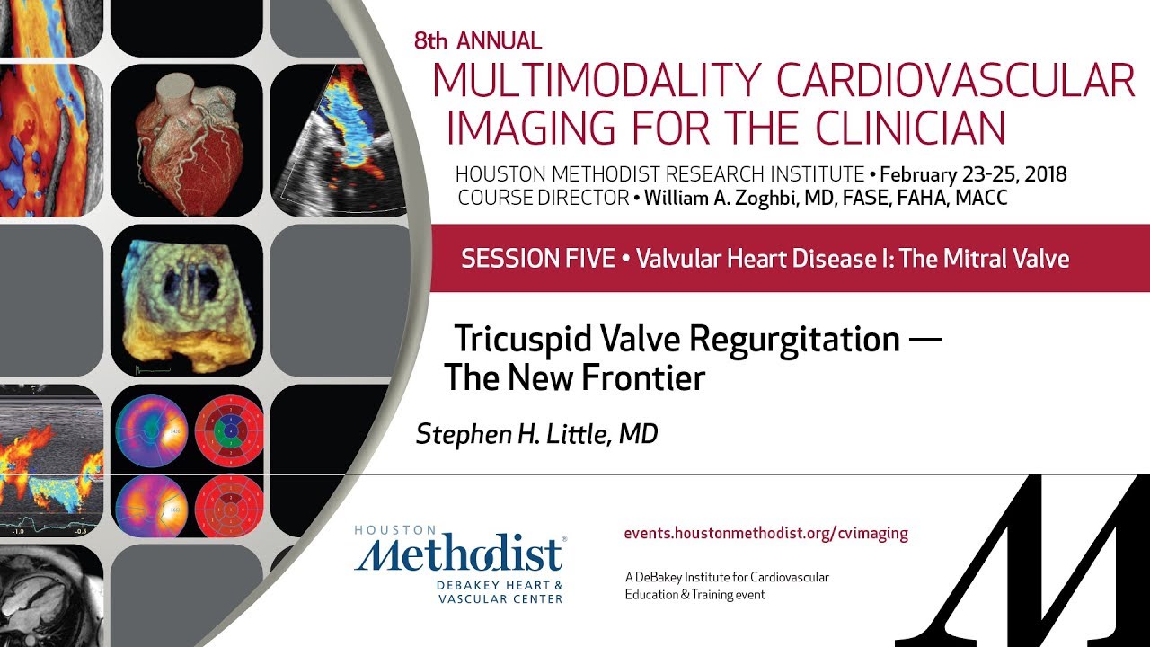 Tricuspid Valve Regurgitation — The New Frontier (STEPHEN H. LITTLE, MD) educational research and reviews