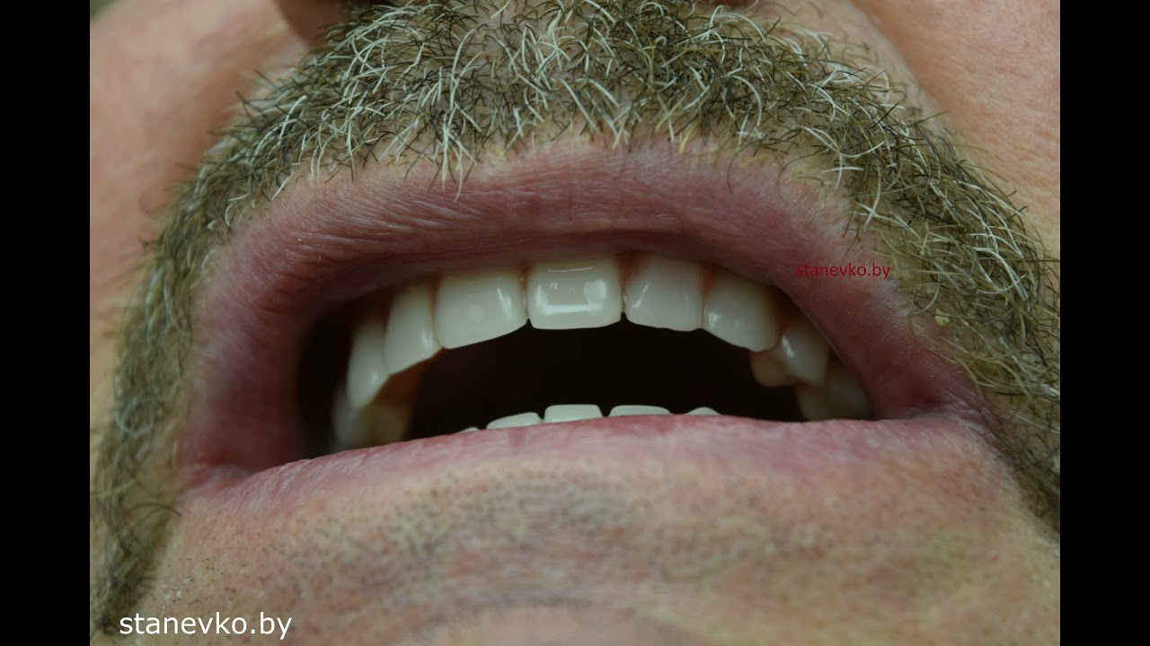 inexpensive implantation of theeth