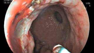 Diagnostic and treatment GI endoscopy Diagnostic and treatment GI endoscopy
