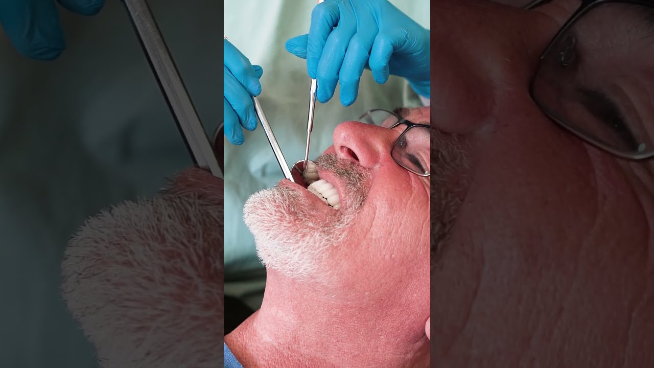 Full Mouth Dental Implants in Turkey – My Honest Med Antalya Review