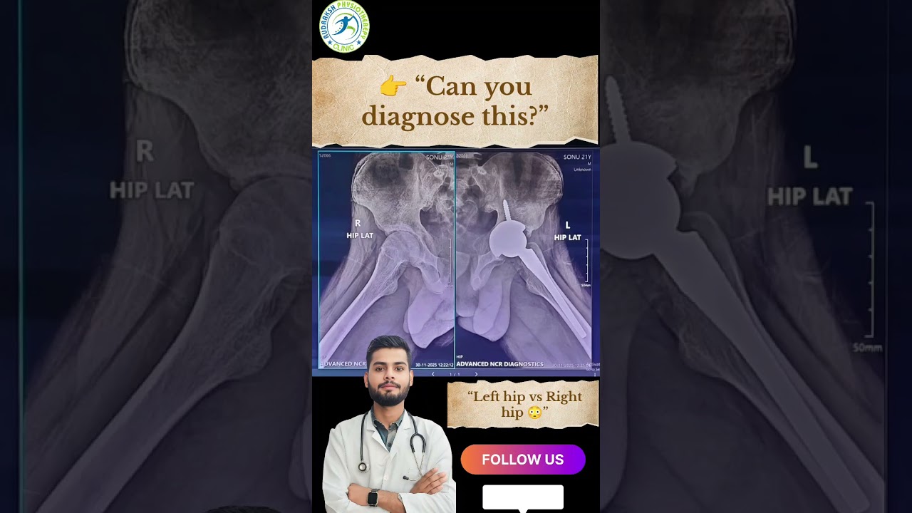 Can You Diagnose This X-Ray? 😳 | Hip Replacement Case 