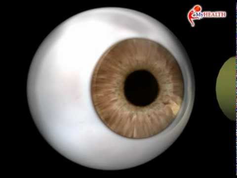 Video: Mikroinvazīvas Glaukomas Operācijas - Intervences Glaukomas Revolūcija