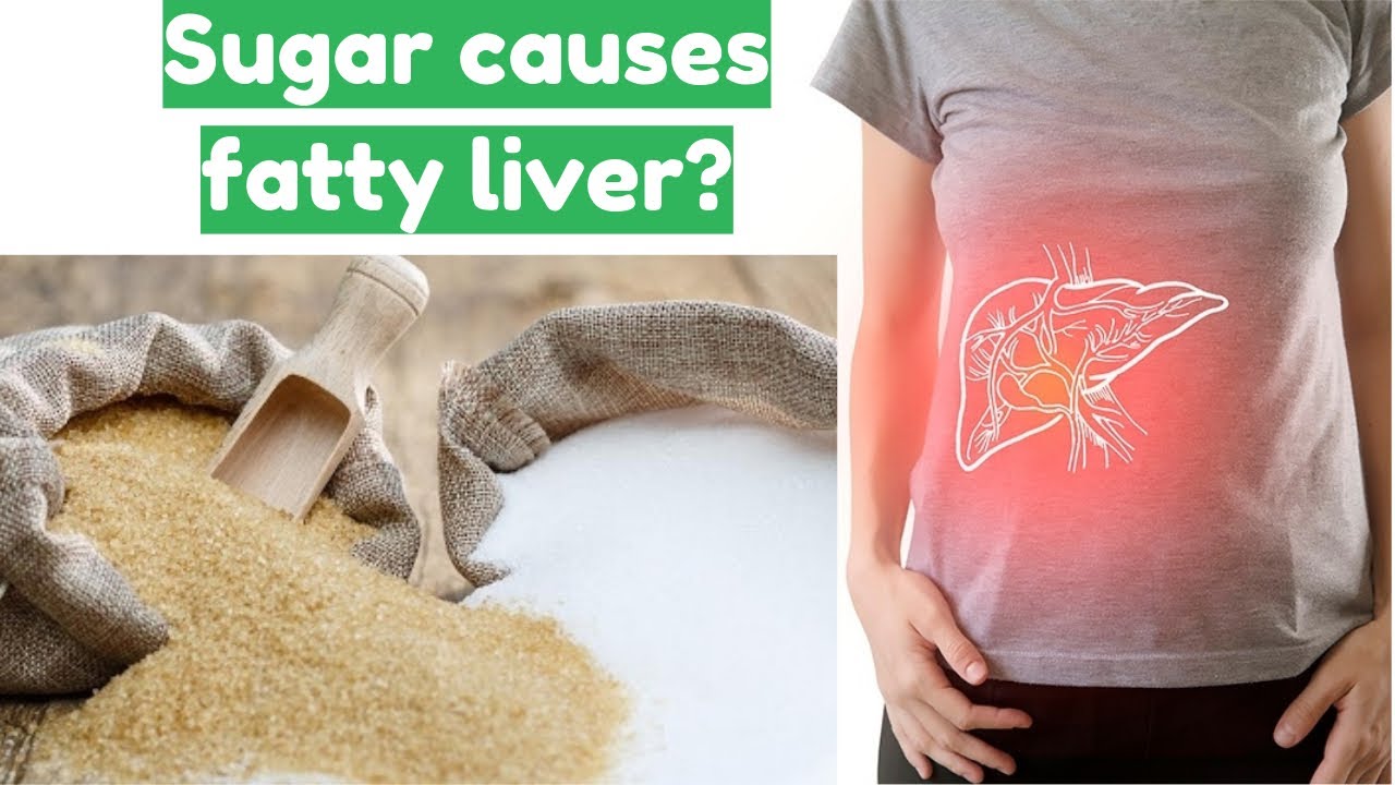 The Truth Behind Sugar And The Cause Of Fatty Liver YouTube