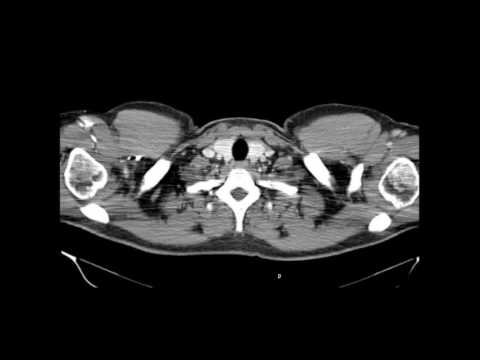 Video: Schwannoma: Symtom, Orsaker, Behandling Och Mer