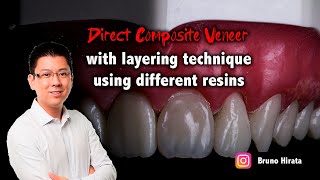 Direct Composite Veneer - The Layering Technique