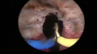 Bipolar Prostate Enucleation(Enucleo-resection)Made Easy/Pre Enucleation Marking Using Collins Knife