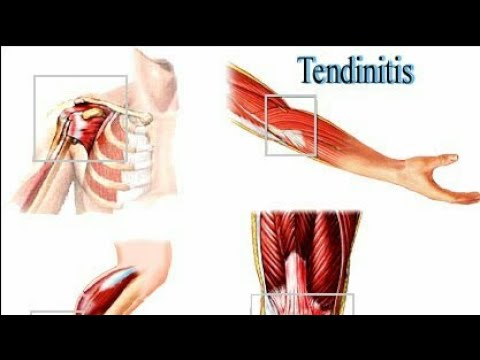 Tendinitis antebrazo tratamiento