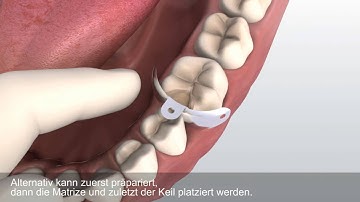 Das V3 Matrizensystem von Triodent