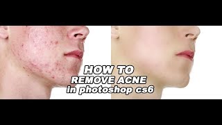 How To Remove Acne In Photoshop Cs6