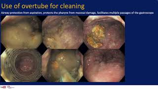 Lecture on Third Space Endoscopy by Dr Mavrogenis Georgios