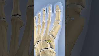 Bunionectomy Explained Foot Surgery Without The Confusion