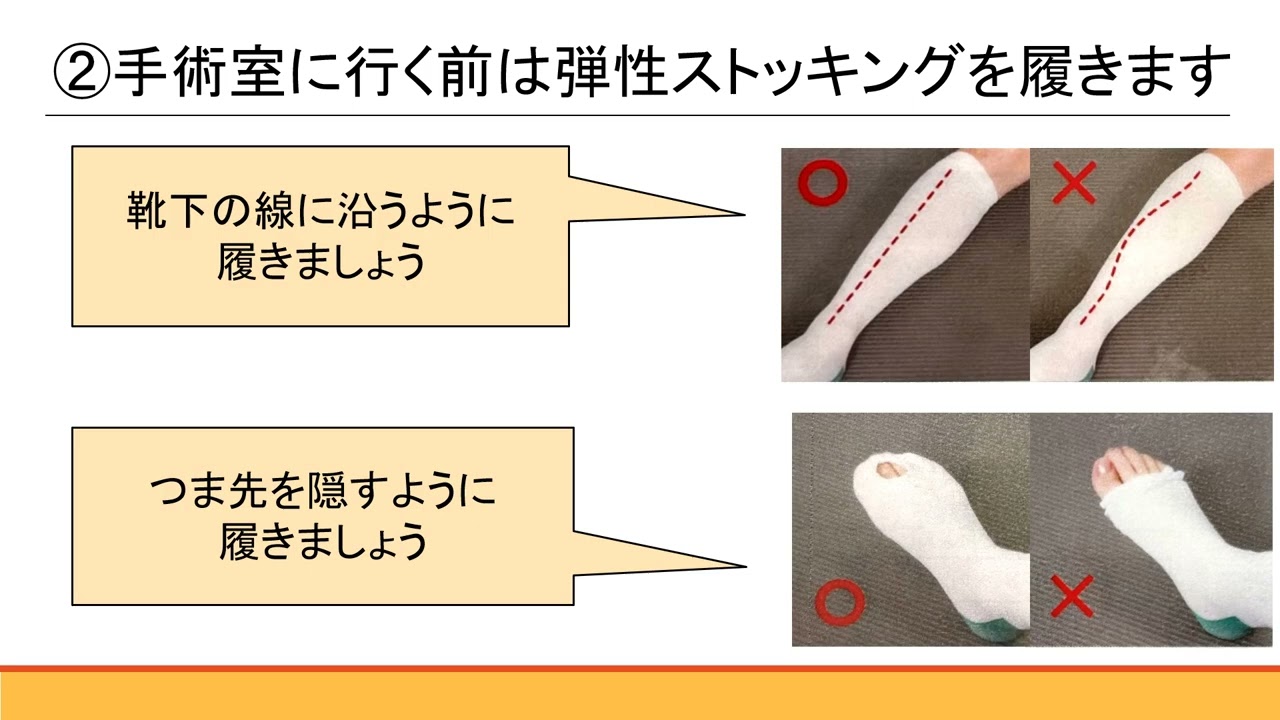 人工股関節全置換術後の深部静脈血栓症予防について - YouTube