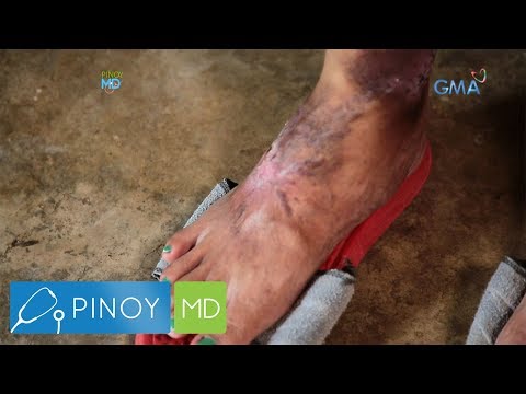 Video: Paano Mapagaling ang Patuyong Balat sa Mga binti (may Mga Larawan)
