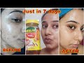 7 days Challenge- Remove Pimple Marks & Acne Scars Naturally at Home | पिंपल्स के दाग हटाने के उपाय