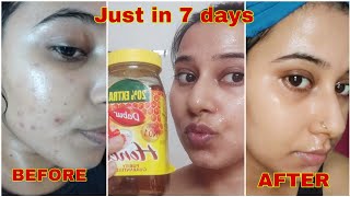 7 days Challenge- Remove Pimple Marks & Acne Scars Naturally at Home | पिंपल्स के दाग हटाने के उपाय screenshot 1