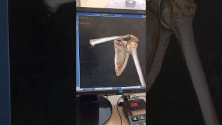 Ct scan of Scapula 3D image