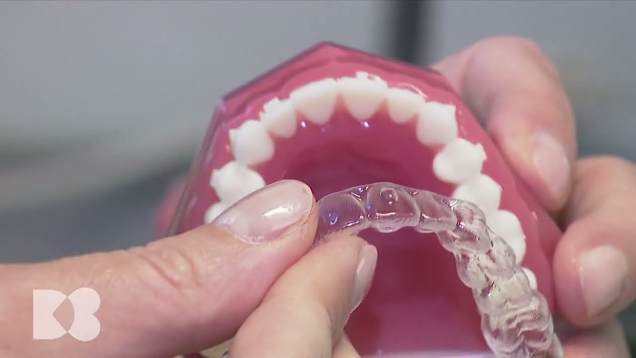 Gutiera: înlocuitorul estetic al aparatului dentar