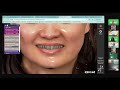 Smile Design 3D/ Nguyễn Huy Hoàng