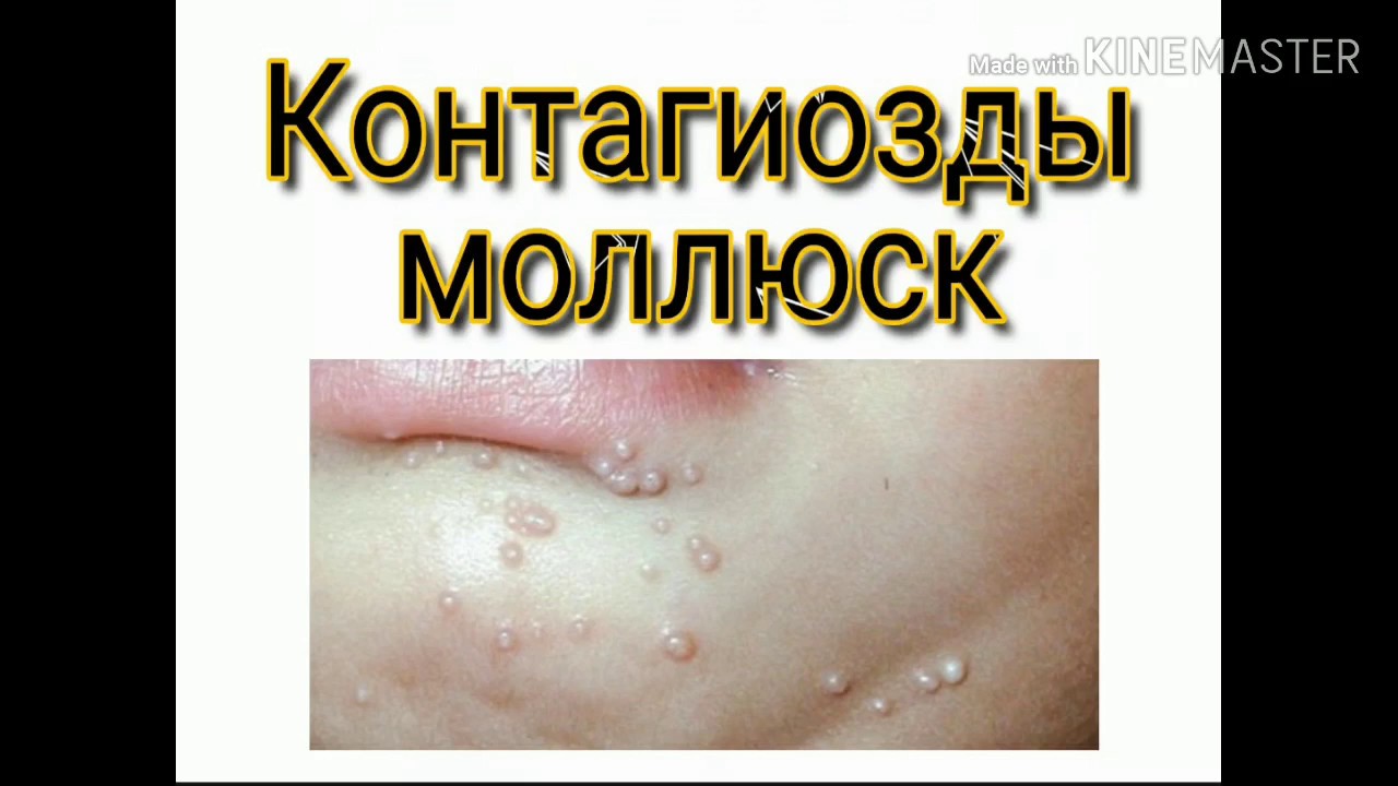 Контагиозный моллюск. Причина. Лечение. Емі себебі. - YouTube