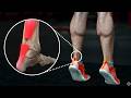 Achilles tendon rupture rehab education  stretching  strengthening exercises  return to sport