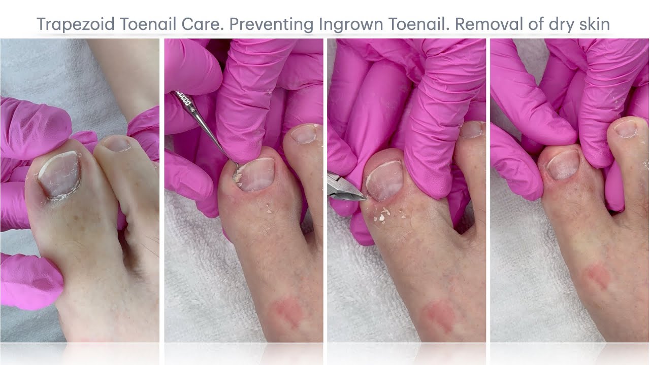 ❗️Deep Toenail Cleaning for Instant Relax🔥🫠⛑️ASMR 