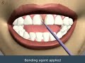 gap closure by dental veneers