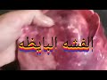 الفشه البايظه والفشه السليمه 