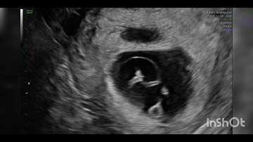 Twin reversed arterial perfusion (TRAP) sequence ( acardia) fetal ultrasound.