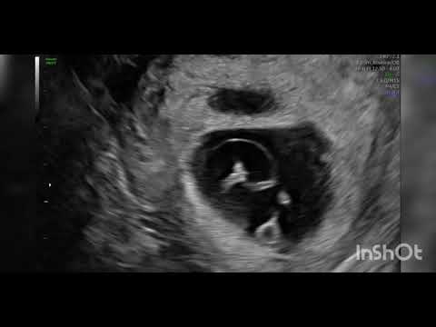 Twin reversed arterial