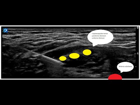 Sala Block Use Method Superior trunk block - Sala-Blanch approach Nervus suprascapularis ...