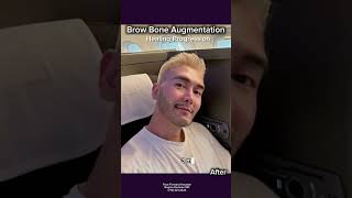 Brow Bone Implant| Brow Bone Augmentation| Facial Plastic Surgery