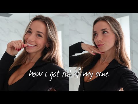 how to actually get rid of acne