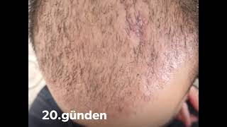 Saç Ekimi 3 Aylık Süreç Kafada Yara Oluştu