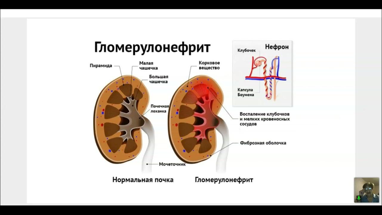 Воспаление почек гломерулонефрит. Гломерулонефрит воспаление клубочков почки. Клиническая классификация острого гломерулонефрита. Хронический гломерулонефрит почка. Хронический гломерулонефрит клинические проявления.