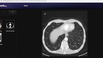 TEAM FRCR 2B Viva Practice Session (Chest Module). 2nd Jan, 2021.