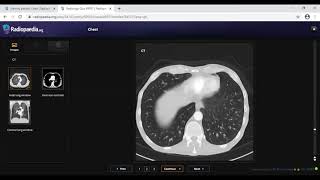 TEAM FRCR 2B Viva Practice Session (Chest Module). 2nd Jan, 2021.