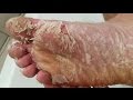 Skin Peels off Foot (Chemical Peel) Gross!