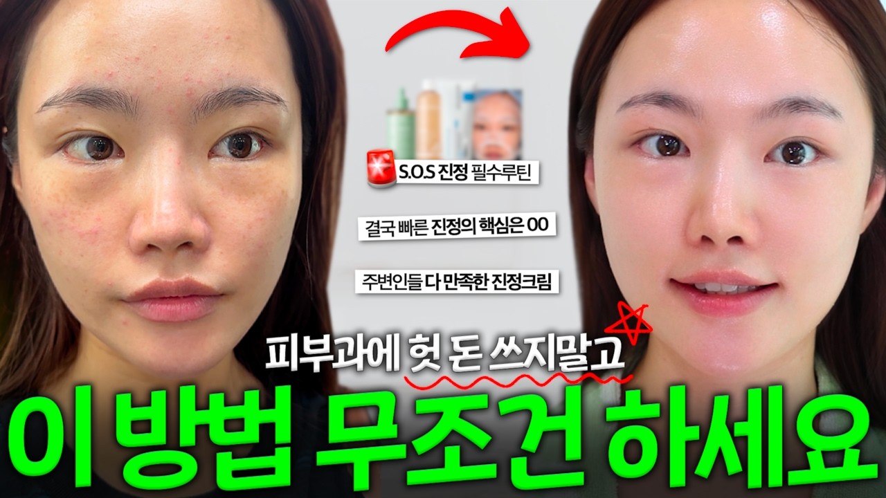 여드름이 있다면 무조건 클릭하세요, 이것저것 안 하고 딱 5단계로 여드름 진정 가능해요