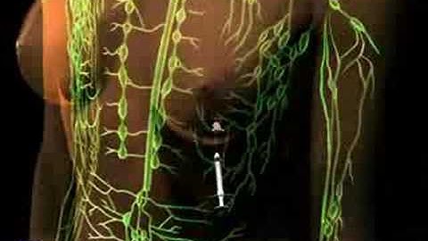 Sentinel Lymph Node Biopsy