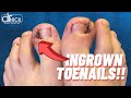 How To Fix an Ingrown Toenail with Surgery! UNEDITED! | Dr. Nick Campitelli