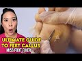 Ultimate Guide to Feet Callus |  Causes, Prevention &amp; Treatment By Famous Podiatrist Miss Foot Fixer